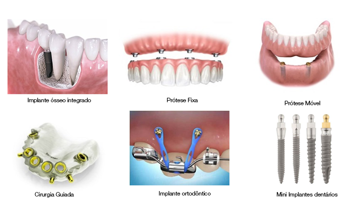 O que é Implante Dentário, como fazer?